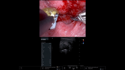 Clinical evaluation of US in TORS