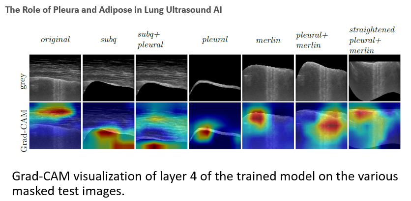 Lung ultrasound COVID-19 segmentation