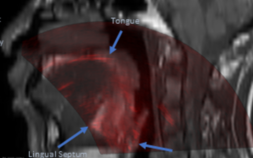 MRI-US registration feasibility study